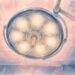 Bright surgical lights in operating room — Wendy Lenz personal essay on her seventh surgery
